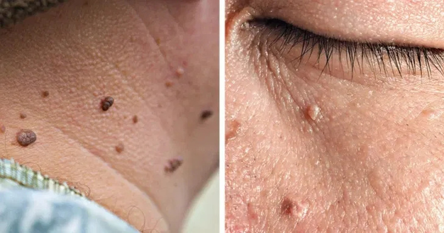 9 Wa:rning Signs of Diabetes You Might Be Overlooking