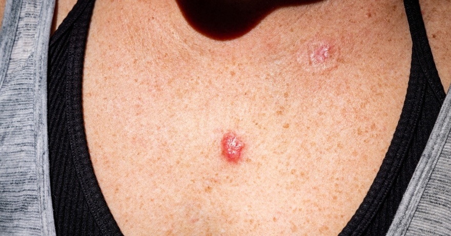 20 Early Signs Your Body is Fighting Cancer