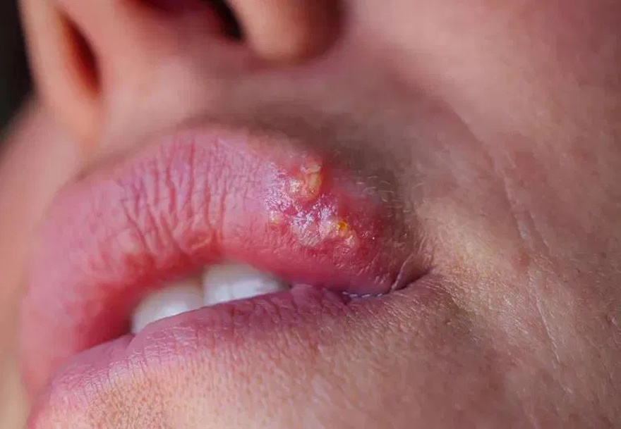 Be very careful if it comes out in your mouth, you are infected