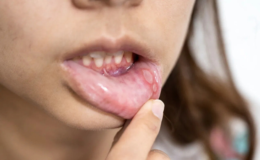 Be very careful if it comes out in your mouth, you are infected