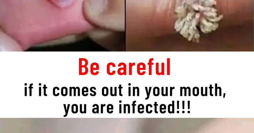 Be very careful if it comes out in your mouth, you are infected