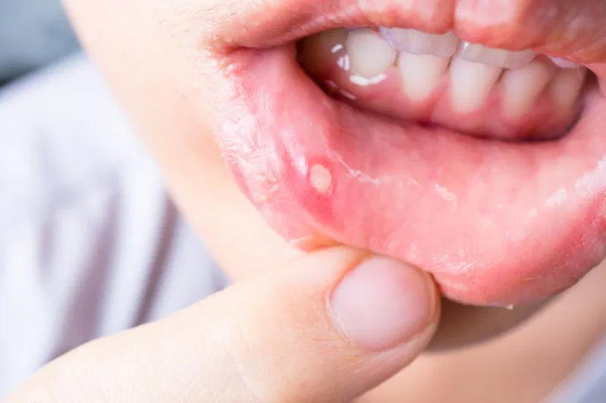 Be very careful if it comes out in your mouth, you are infected