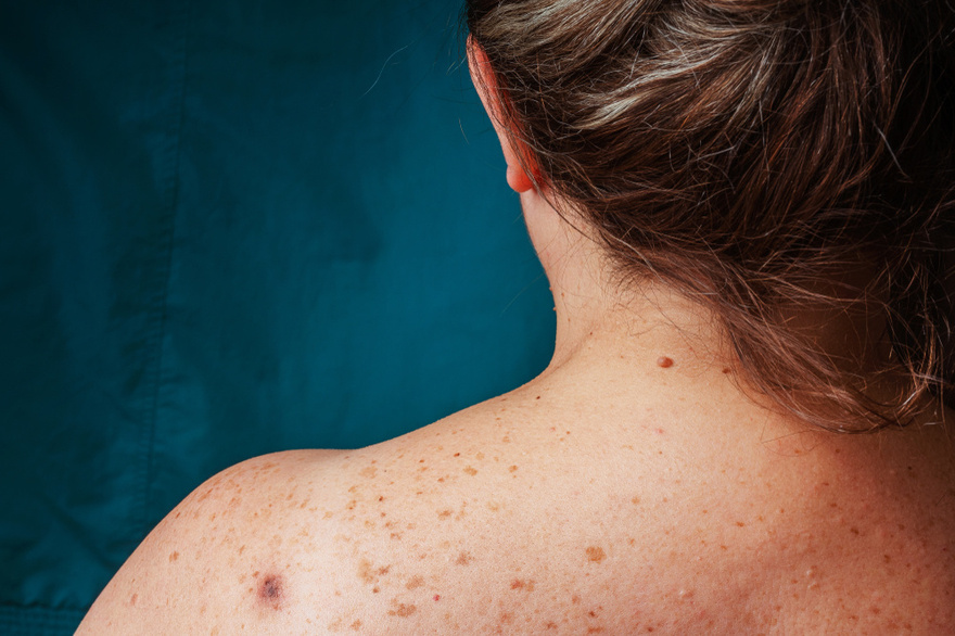 How To Reduce Age Spots: Causes, Treatment, and Prevention