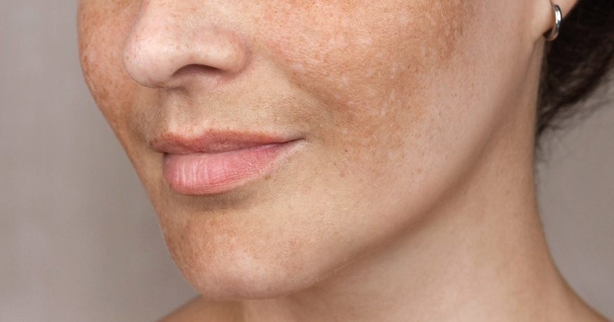 How To Reduce Age Spots: Causes, Treatment, and Prevention