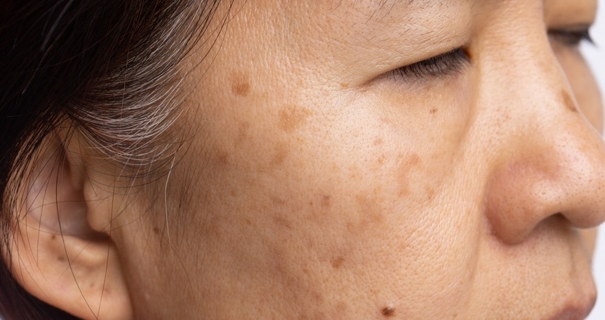 How To Reduce Age Spots: Causes, Treatment, and Prevention