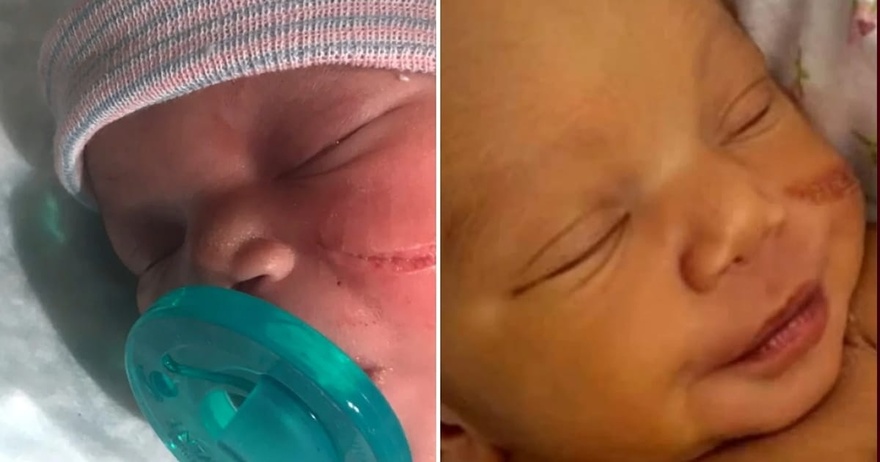 Newborn baby needs 13 stitches after surgeon ripped open her face during C-section Newborn baby needs 13 stitches after surgeon ripped open her face during C-section