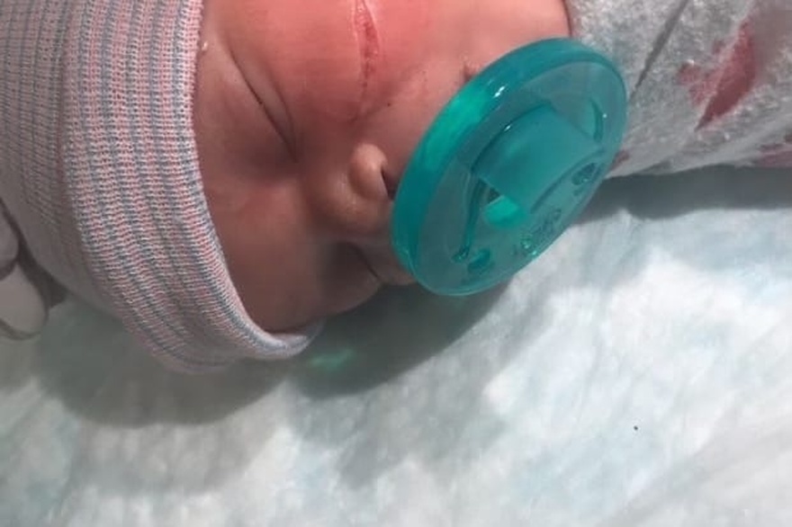Newborn baby needs 13 stitches after surgeon ripped open her face during C-section Newborn baby needs 13 stitches after surgeon ripped open her face during C-section