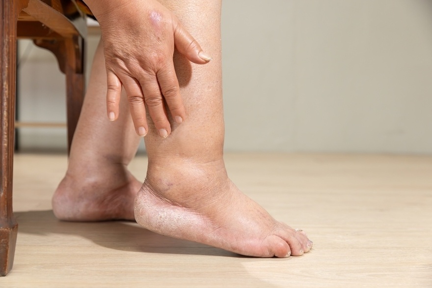 10 Symptoms of Diabetes That May Show Up In Your Feet