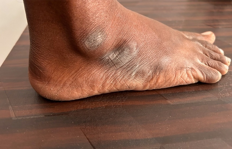 10 Symptoms of Diabetes That May Show Up In Your Feet