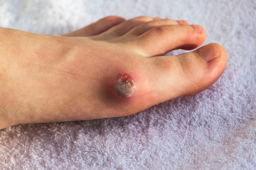 10 Symptoms of Diabetes That May Show Up In Your Feet
