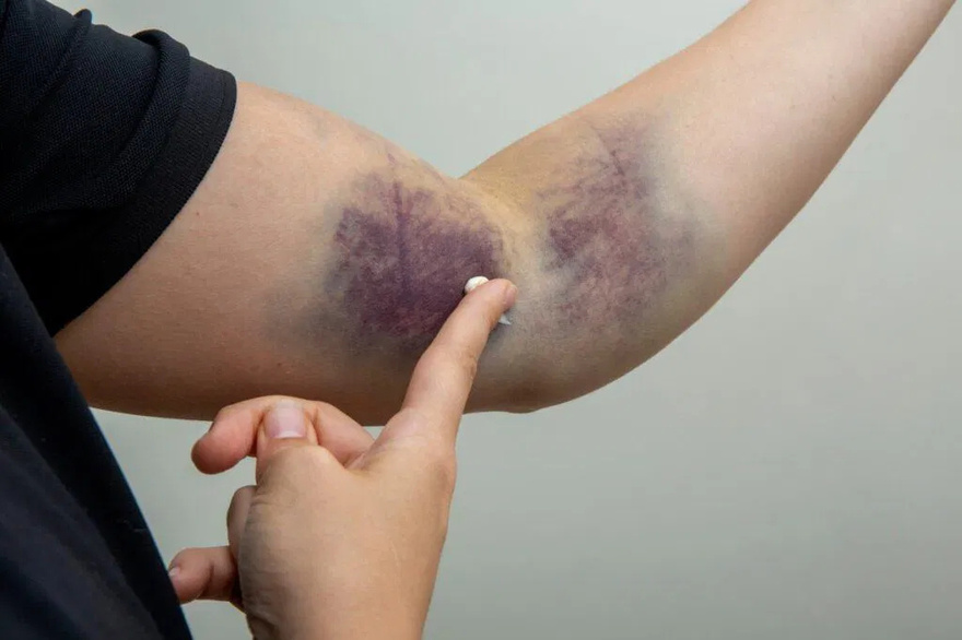 Why do bruises appear without being hi.t?