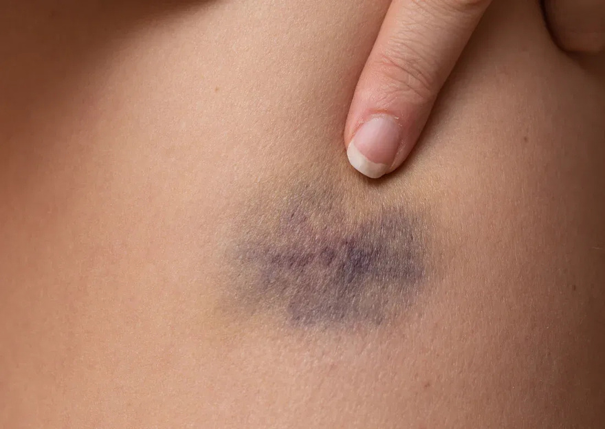 Why do bruises appear without being hi.t?