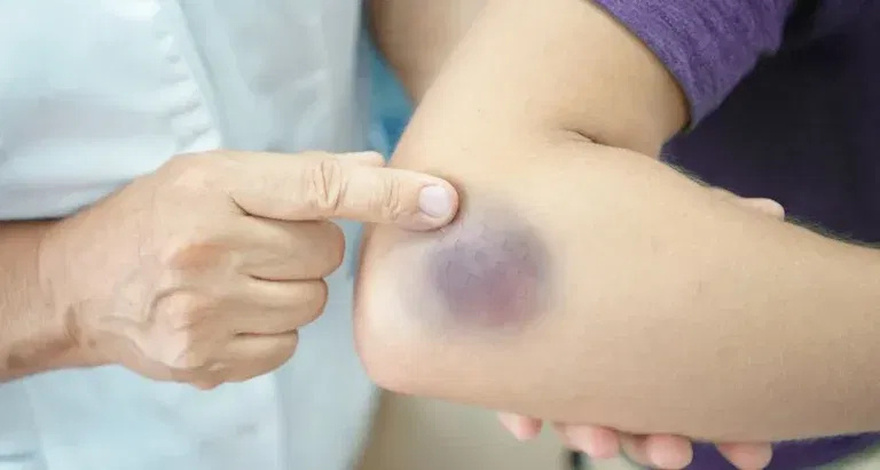 Why do bruises appear without being hi.t?