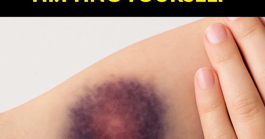 Why do bruises appear without being hi.t?