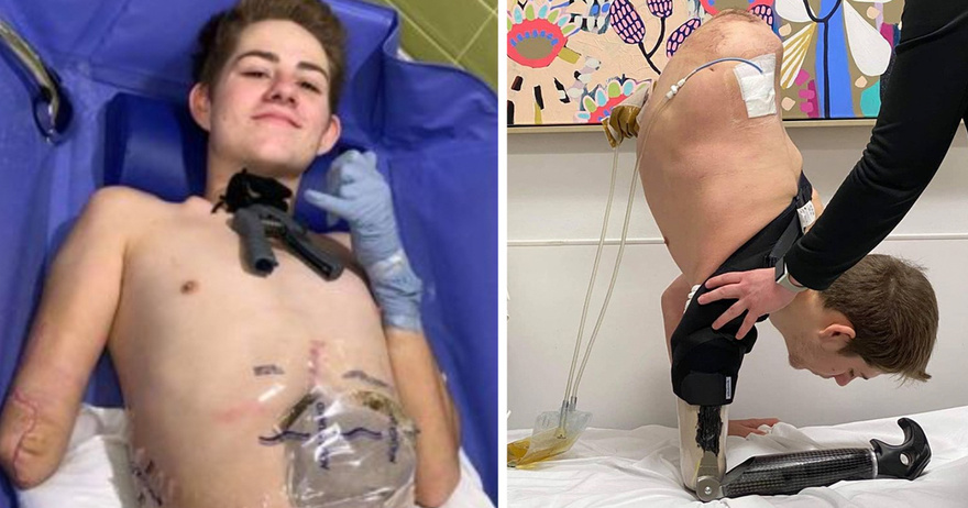 19-year-old crushed by forklift chooses to amputate bottom half of his body