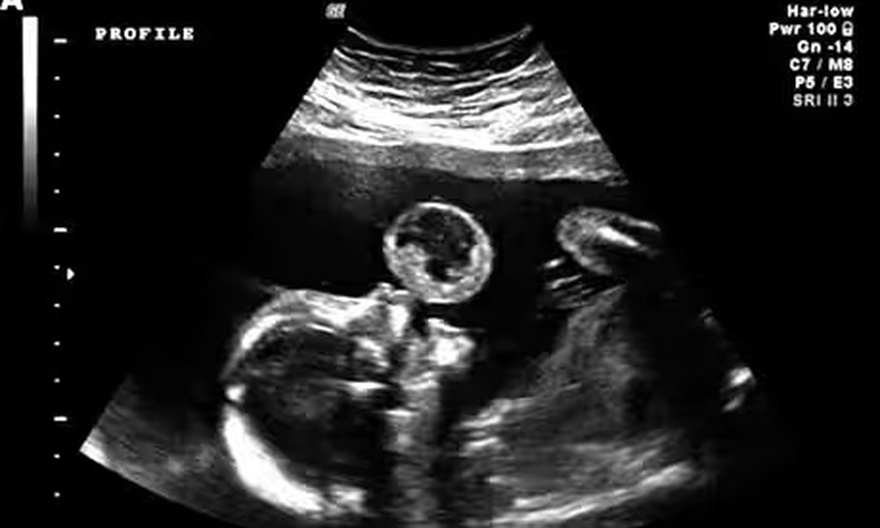Mother’s Ultrasound Shows Baby ‘Blowing Bubbles’ Then Doctors Discovered What It Really Was
