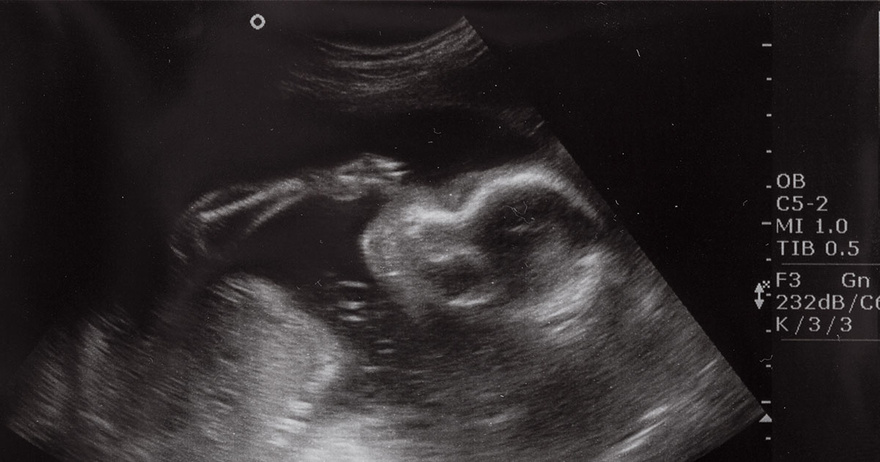 Mother’s Ultrasound Shows Baby ‘Blowing Bubbles’ Then Doctors Discovered What It Really Was