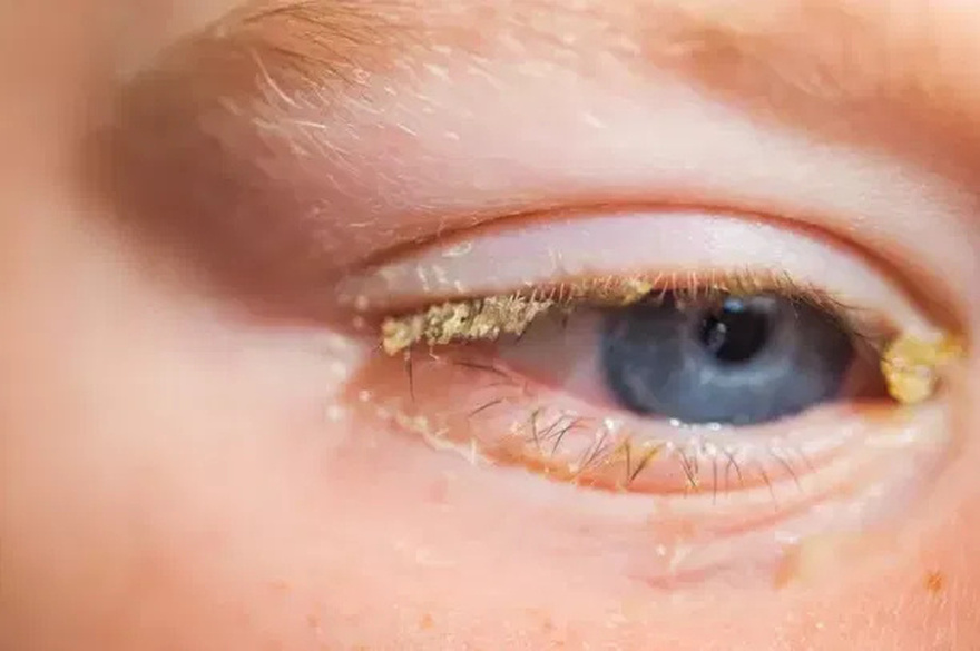 People disturbed after realising what yellow stuff in your eyes when you wake up actually is