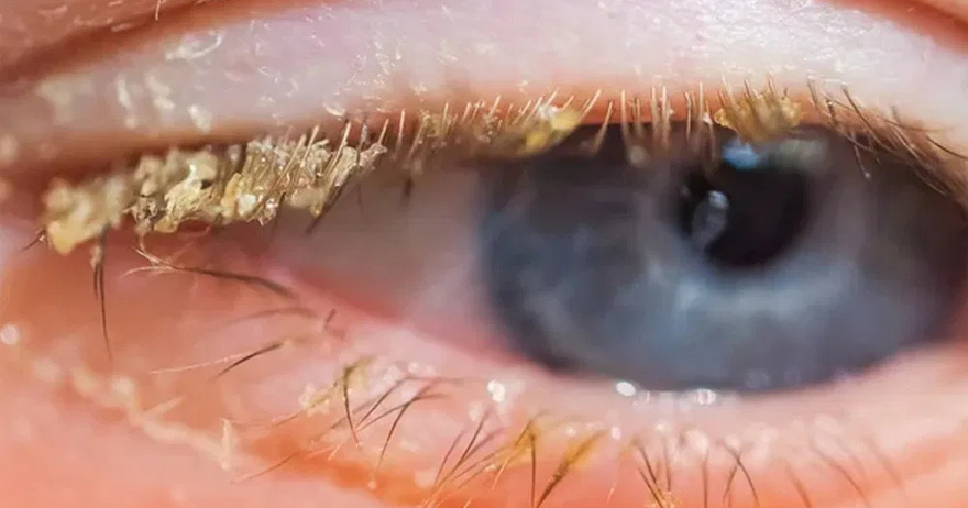 People disturbed after realising what yellow stuff in your eyes when you wake up actually is