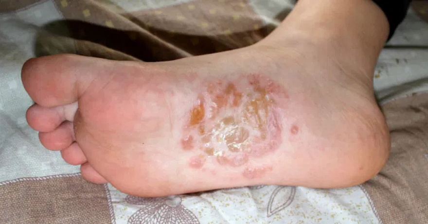 If You See These Painful Red Bumps, Here’s What It Really Means