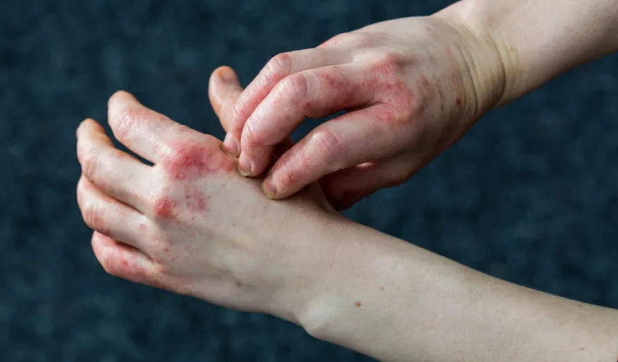If You See These Painful Red Bumps, Here’s What It Really Means