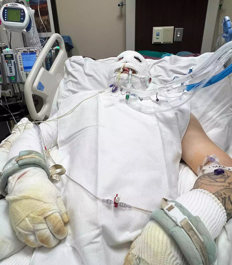 Idaho Man Suffers Third-Degree Burns and Is in a Coma After Freak Accident: ‘I’m Dying! Please Help Me’