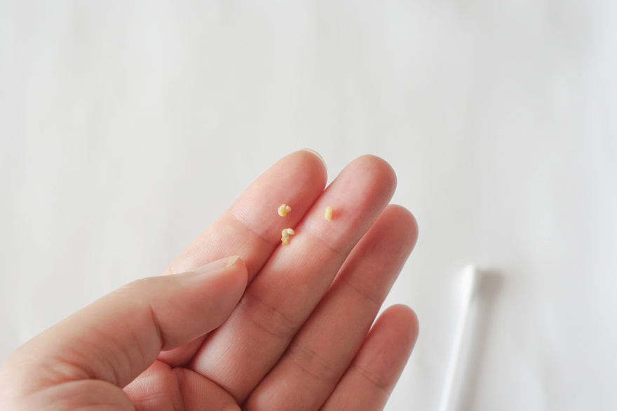 Here’s What You Need to Know About Tonsil Stones