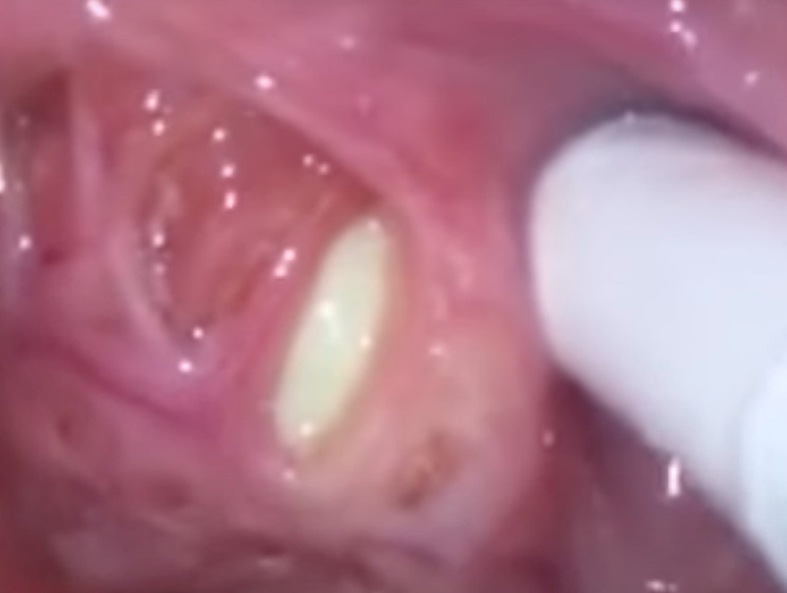 Here’s What You Need to Know About Tonsil Stones