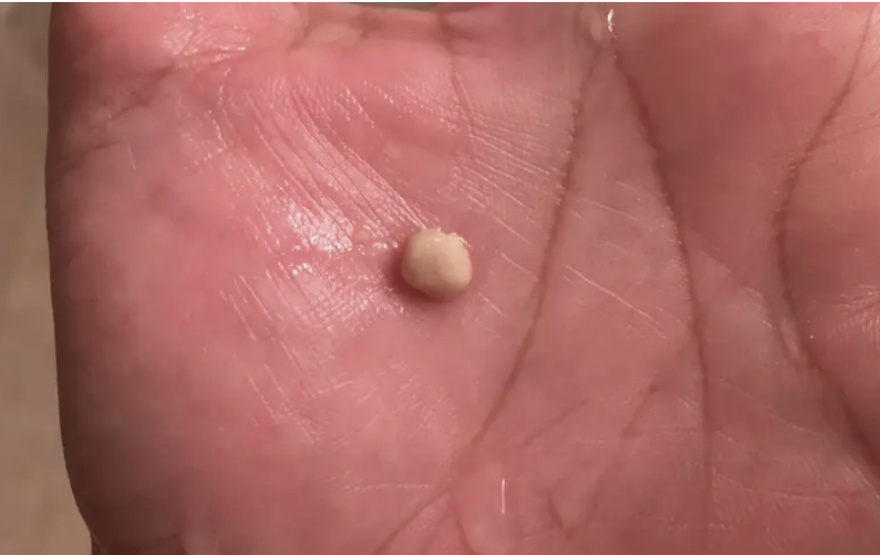 Here’s What You Need to Know About Tonsil Stones