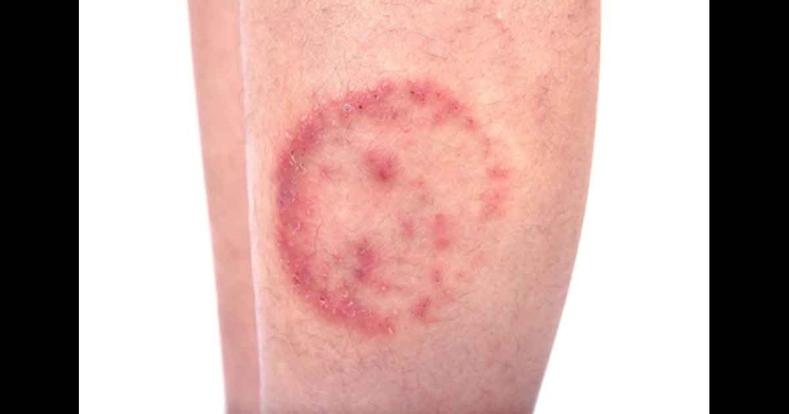 11 Reasons Why You Have Red Dots On Your Skin