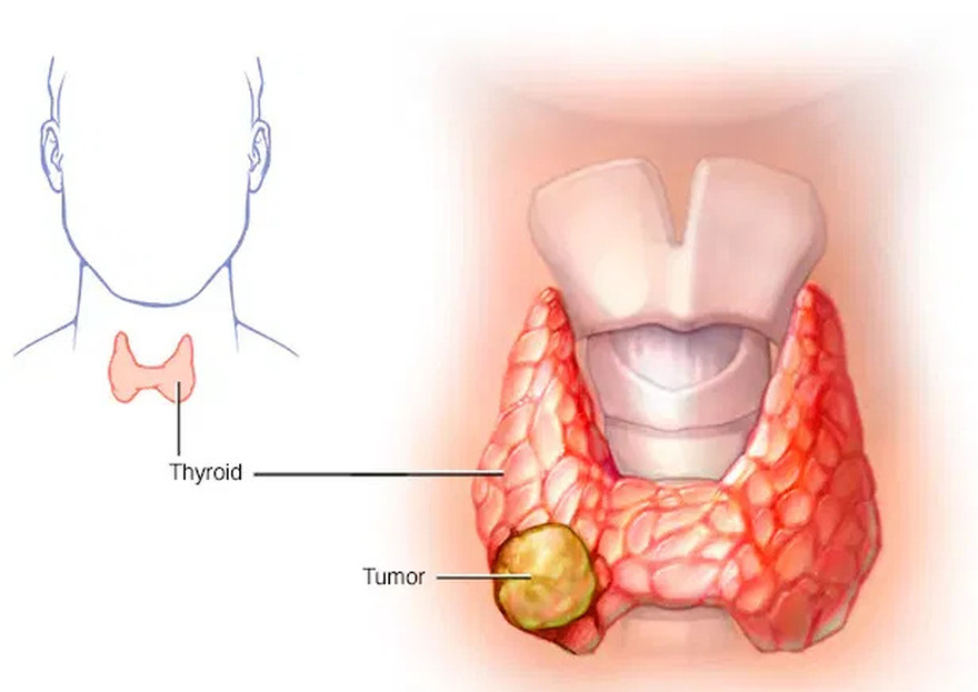Cases of thyroid can:cer are increasing rapidly. Doctors advise you to eat less of these foods