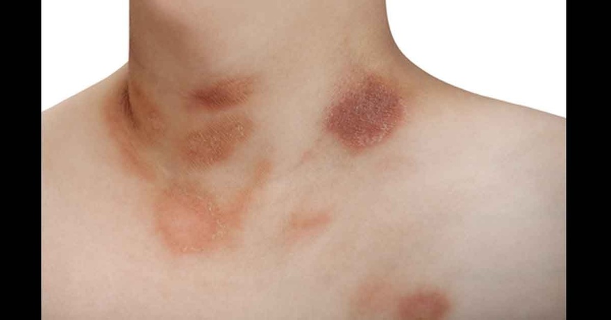 11 Reasons Why You Have Red Dots On Your Skin