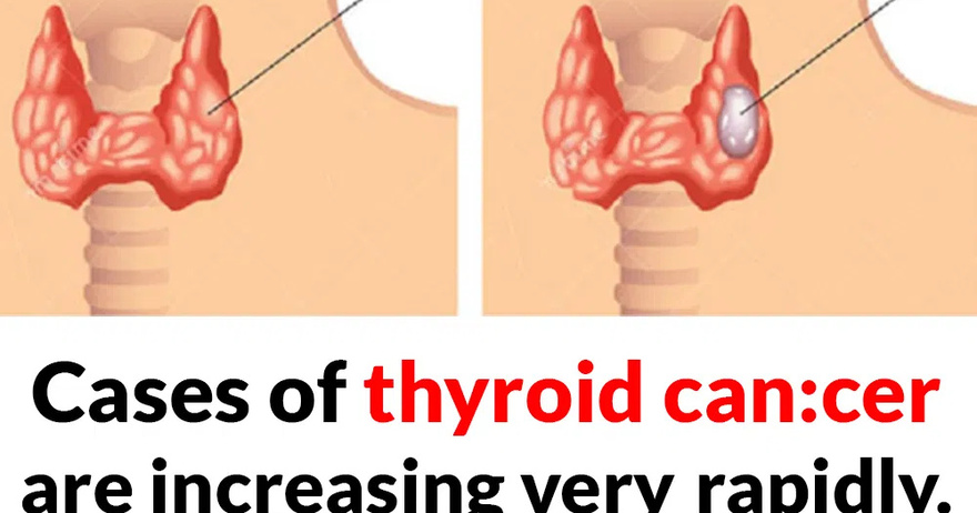 Cases of thyroid can:cer are increasing rapidly. Doctors advise you to eat less of these foods