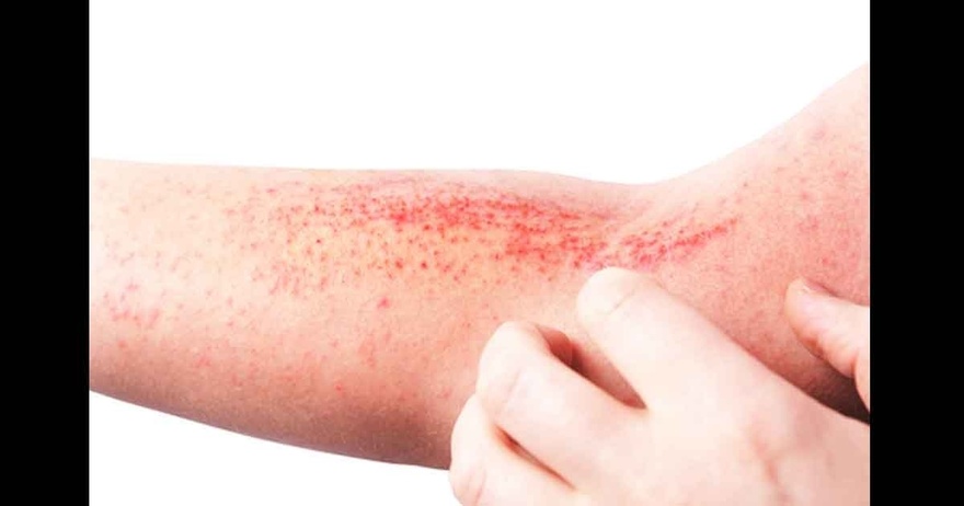 11 Reasons Why You Have Red Dots On Your Skin