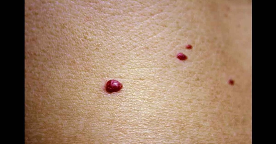 11 Reasons Why You Have Red Dots On Your Skin
