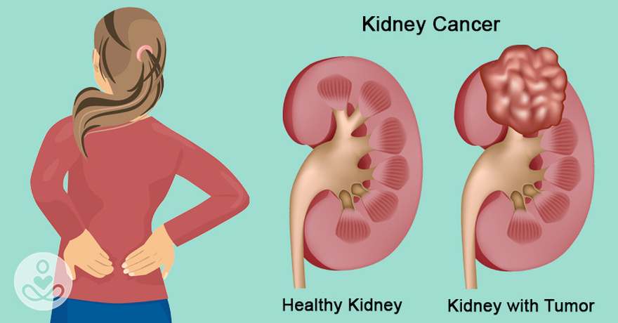 7 early warning signs that cancer is growing inside your kidneys