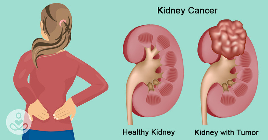 7 early warning signs that cancer is growing inside your kidneys
