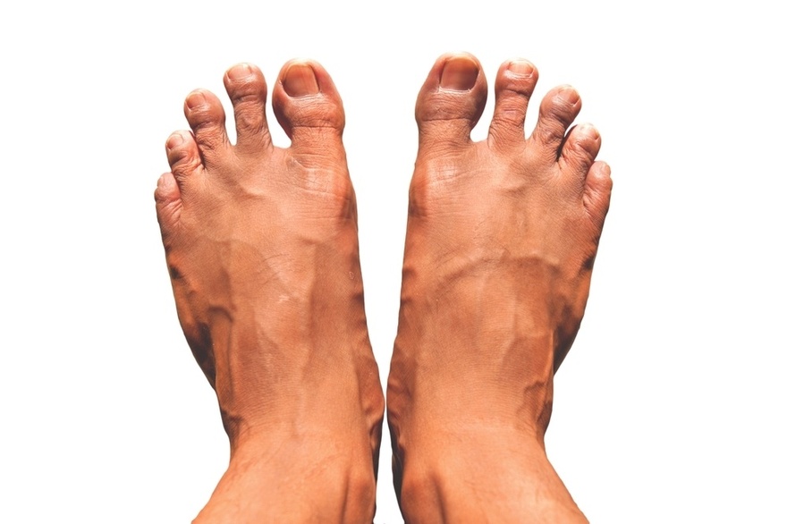 7 Exercises to Help Prevent Spider and Varicose Veins