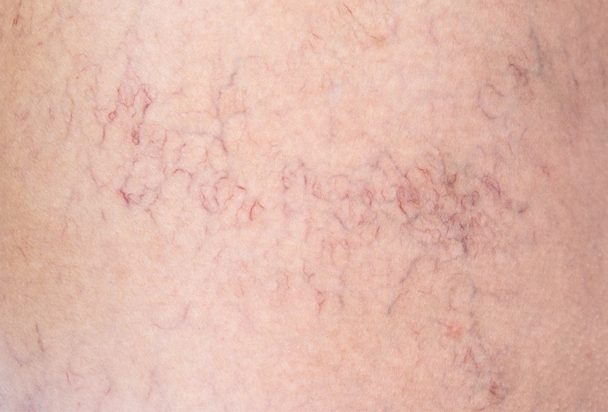 7 Exercises to Help Prevent Spider and Varicose Veins