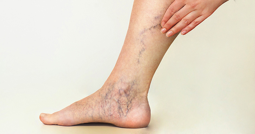 7 Exercises to Help Prevent Spider and Varicose Veins