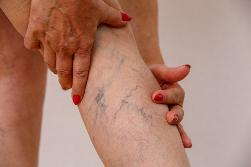 7 Exercises to Help Prevent Spider and Varicose Veins