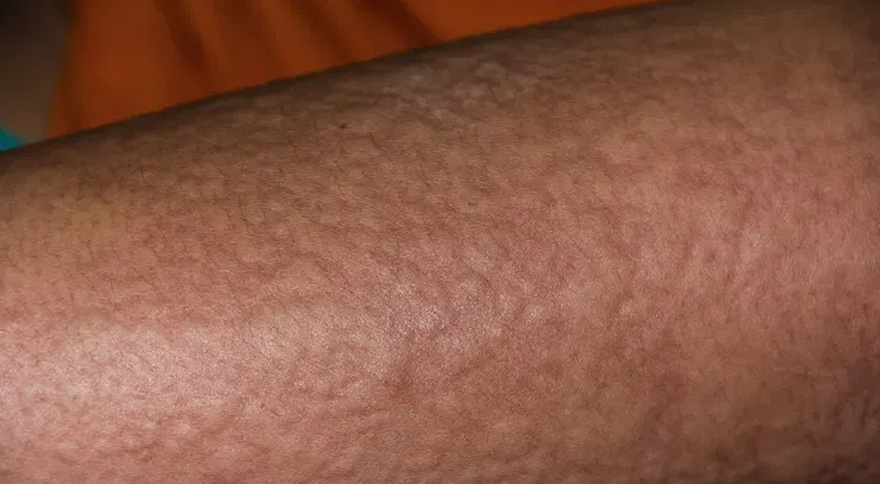 His whole body was itchy, he thought it was an allergy and was diagnosed