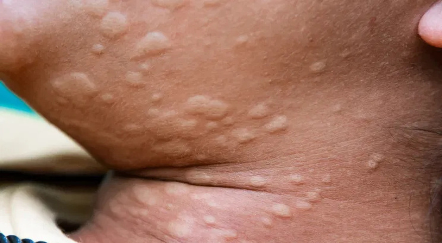 His whole body was itchy, he thought it was an allergy and was diagnosed