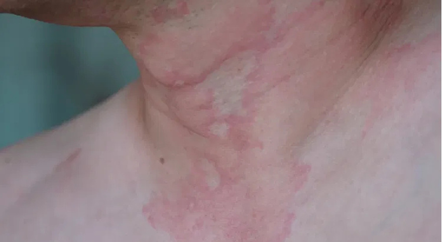 His whole body was itchy, he thought it was an allergy and was diagnosed
