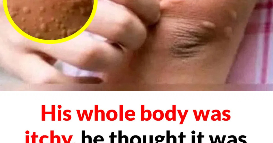 His whole body was itchy, he thought it was an allergy and was diagnosed