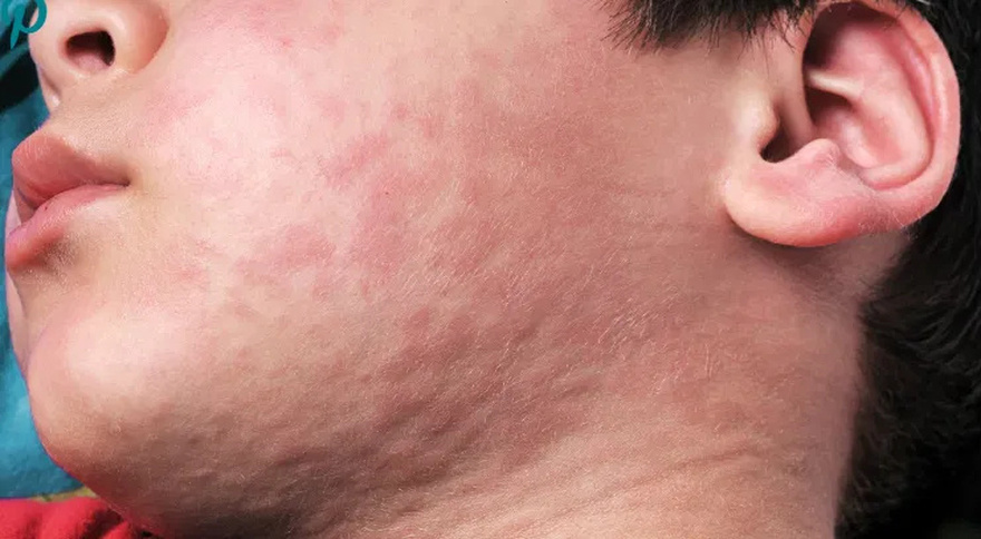 His whole body was itchy, he thought it was an allergy and was diagnosed