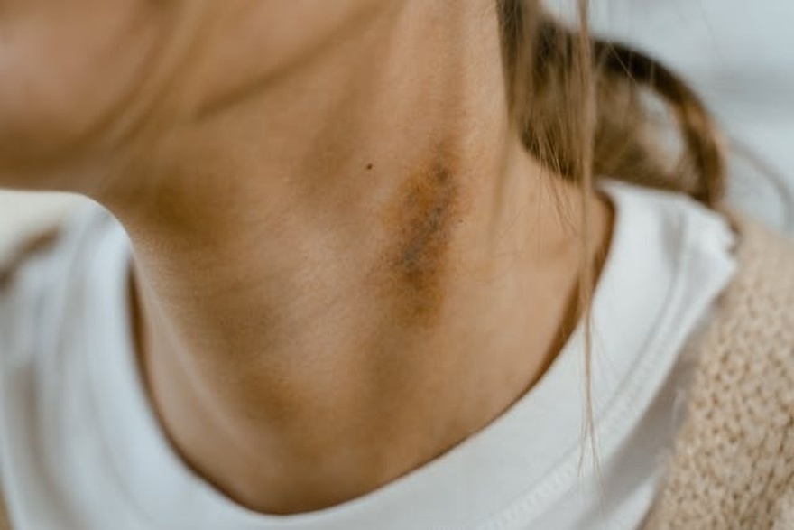 5 Subtle Skin Changes That Could Signal Cancer