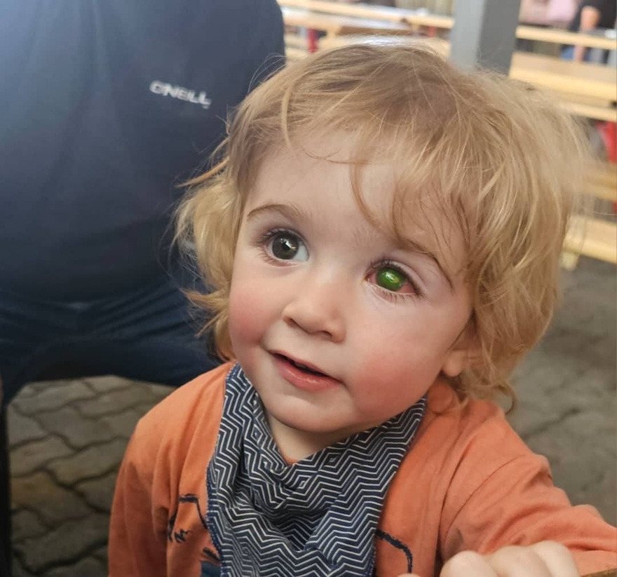 Toddler’s eye ”melts away” after wrong person kissed him