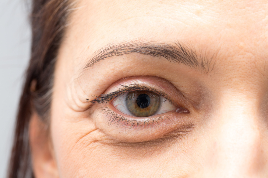 If You Have Dark Eye Circles, Your Body May Be Trying to Warn You