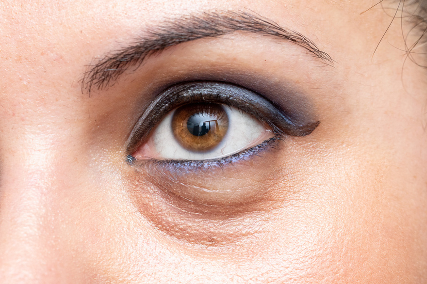 If You Have Dark Eye Circles, Your Body May Be Trying to Warn You